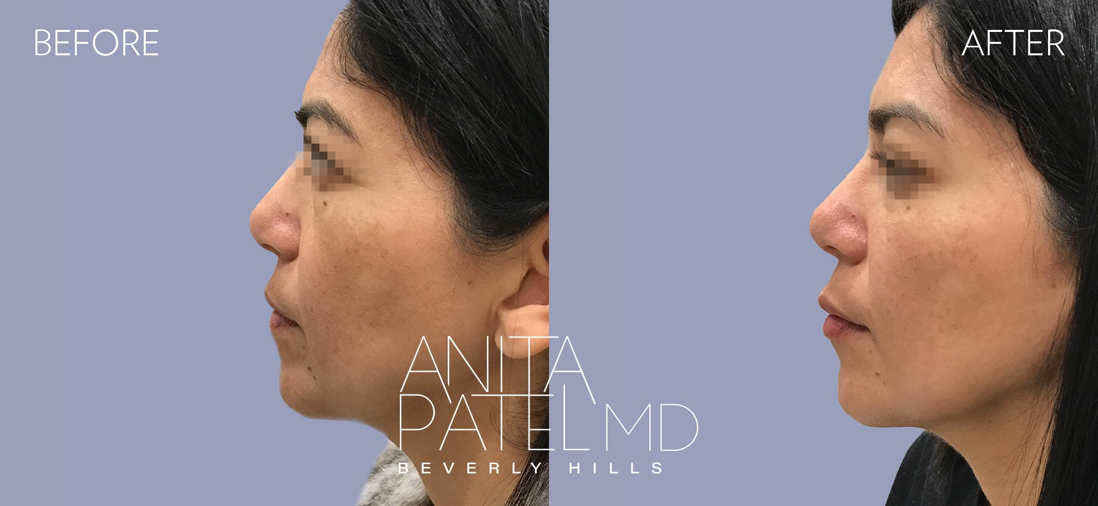 Liquid Makeover® before and after — Patient 6, photo 3 of 5 — Dr. Anita Patel, MD, FACS, Beverly Hills