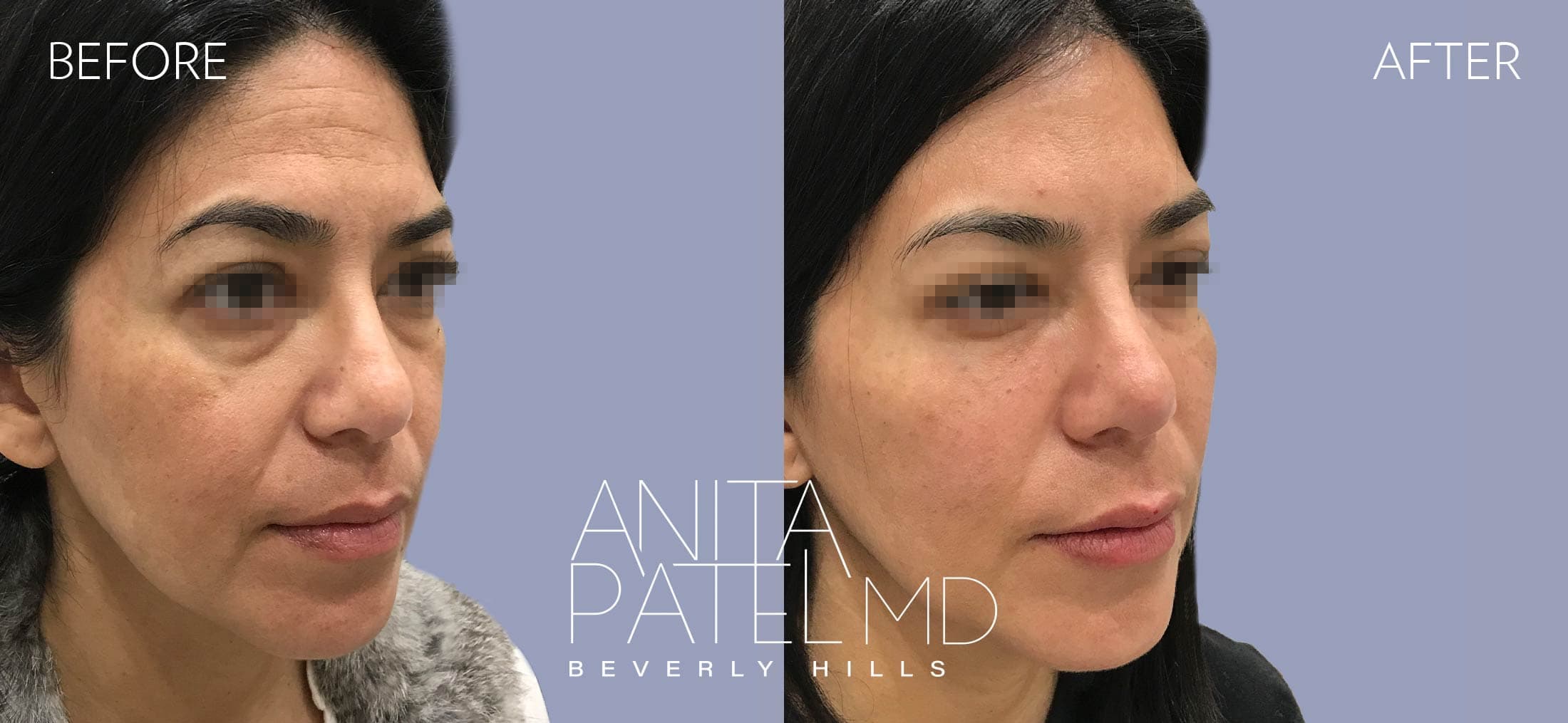 Liquid Makeover® before and after — Patient 6, photo 4 of 5 — Dr. Anita Patel, MD, FACS, Beverly Hills