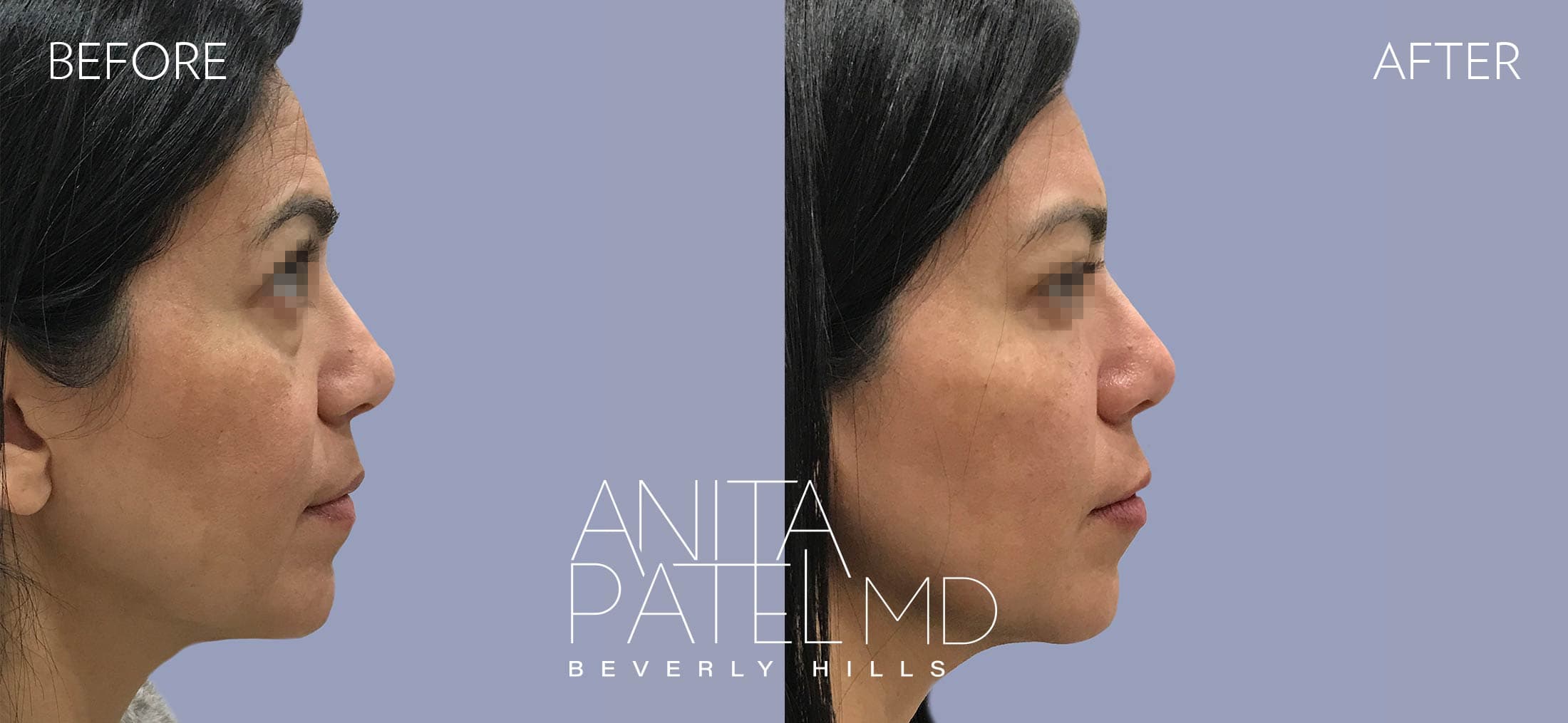 Liquid Makeover® before and after — Patient 6, photo 5 of 5 — Dr. Anita Patel, MD, FACS, Beverly Hills