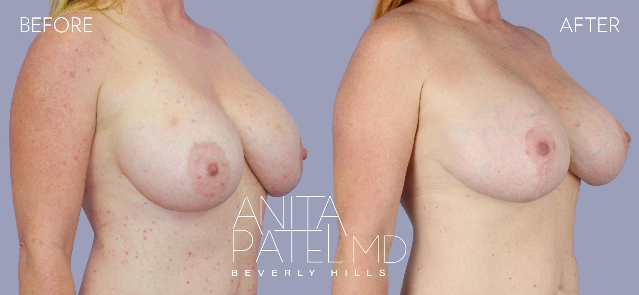 Breast Lift before and after — Patient 12, photo 1 of 2 — Dr. Anita Patel, MD, FACS, Beverly Hills
