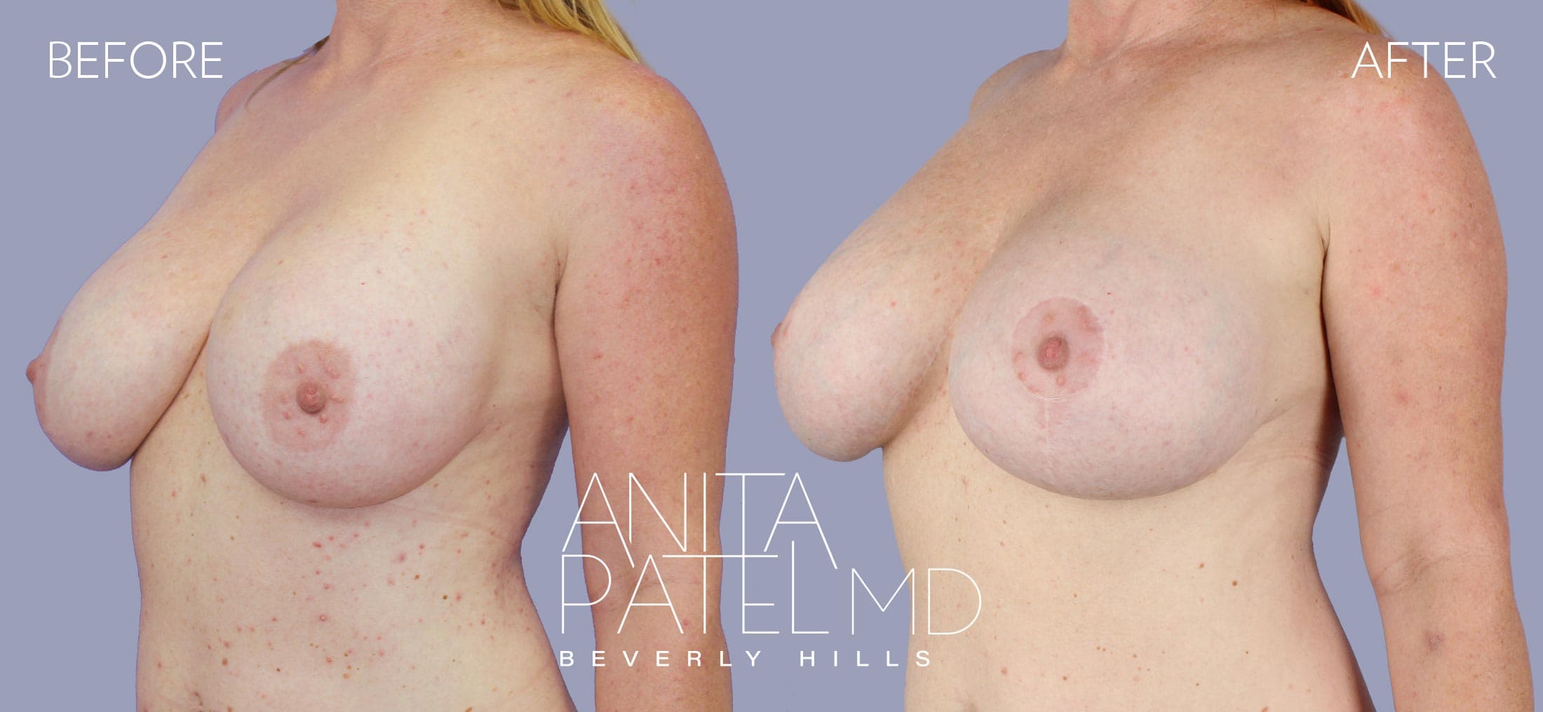 Breast Lift before and after — Patient 12, photo 2 of 2 — Dr. Anita Patel, MD, FACS, Beverly Hills