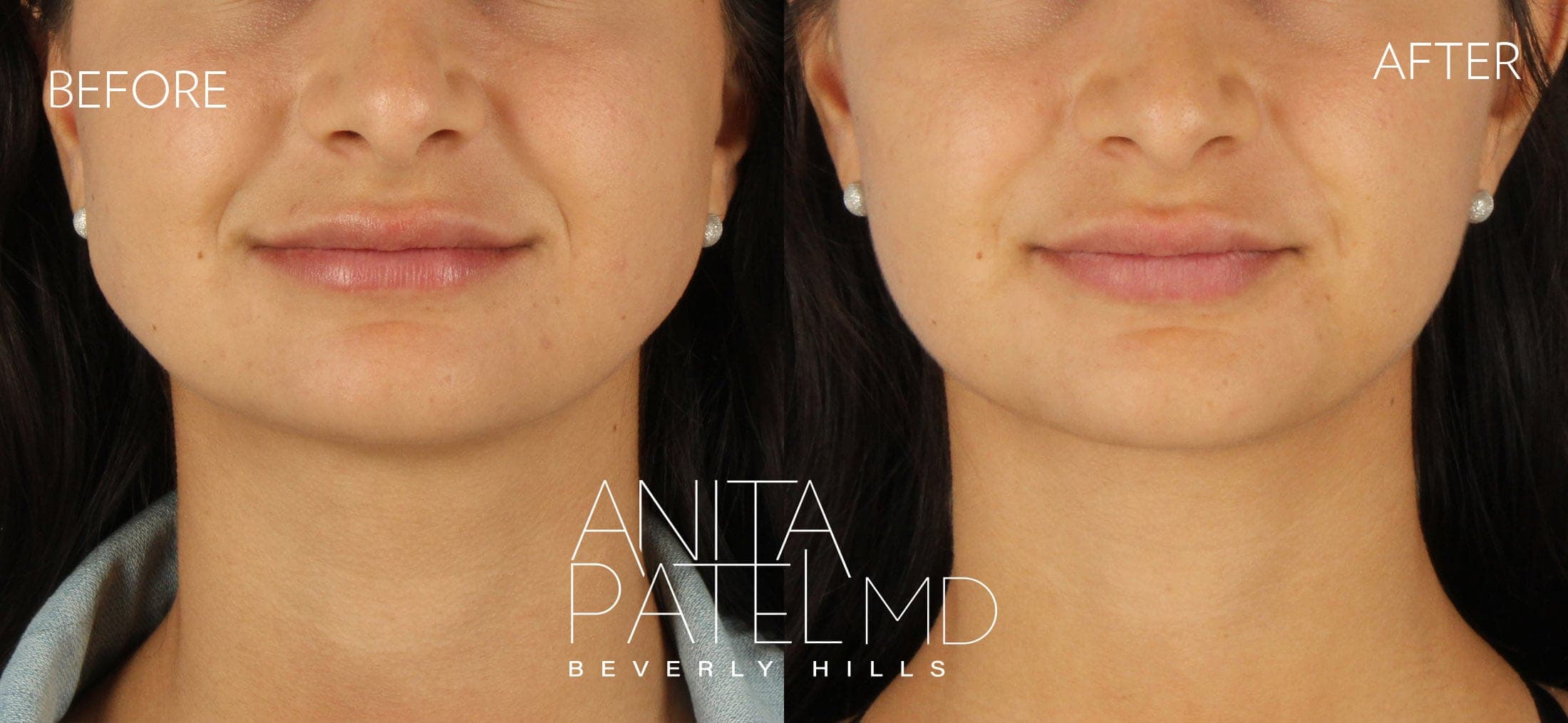 Neurotoxin before and after — Patient 2 — Dr. Anita Patel, MD, FACS, Beverly Hills
