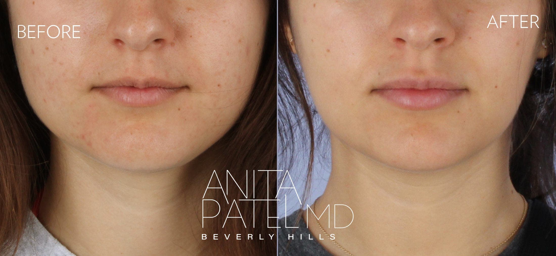 Neurotoxin before and after — Patient 1 — Dr. Anita Patel, MD, FACS, Beverly Hills