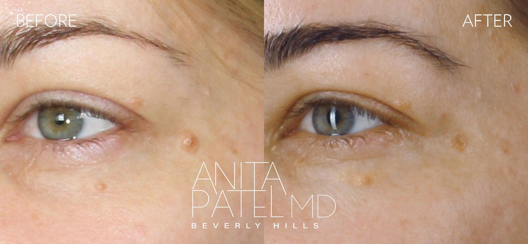 Mole Removal before and after — Dr. Anita Patel, Beverly Hills