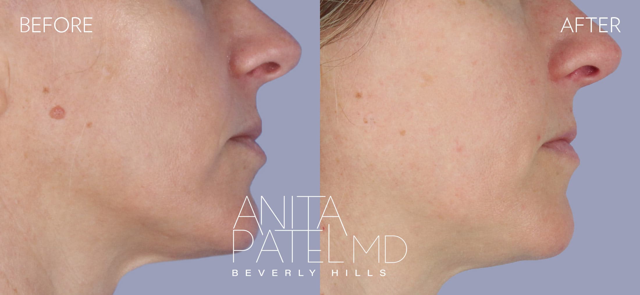 Mole Removal before and after — Patient 4, photo 1 of 3 — Dr. Anita Patel, MD, FACS, Beverly Hills