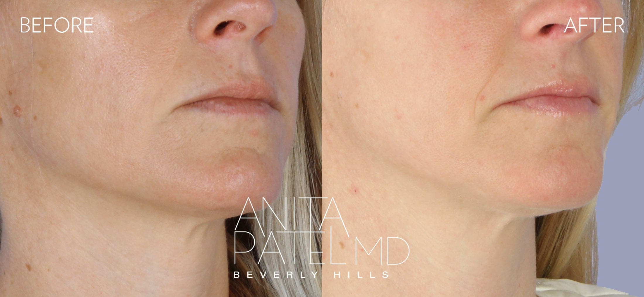Mole Removal before and after — Patient 4, photo 2 of 3 — Dr. Anita Patel, MD, FACS, Beverly Hills