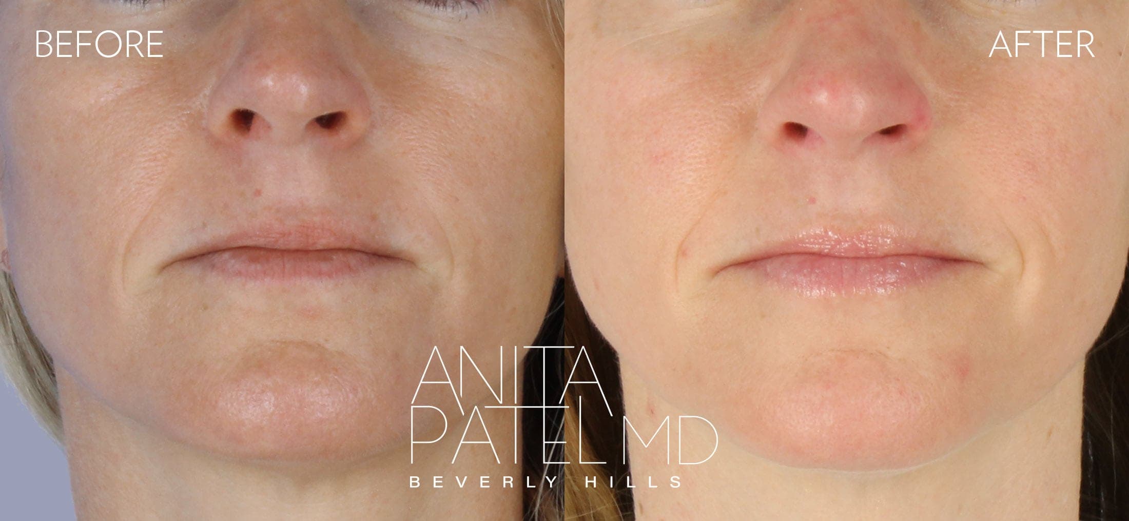 Mole Removal before and after — Patient 4, photo 3 of 3 — Dr. Anita Patel, MD, FACS, Beverly Hills