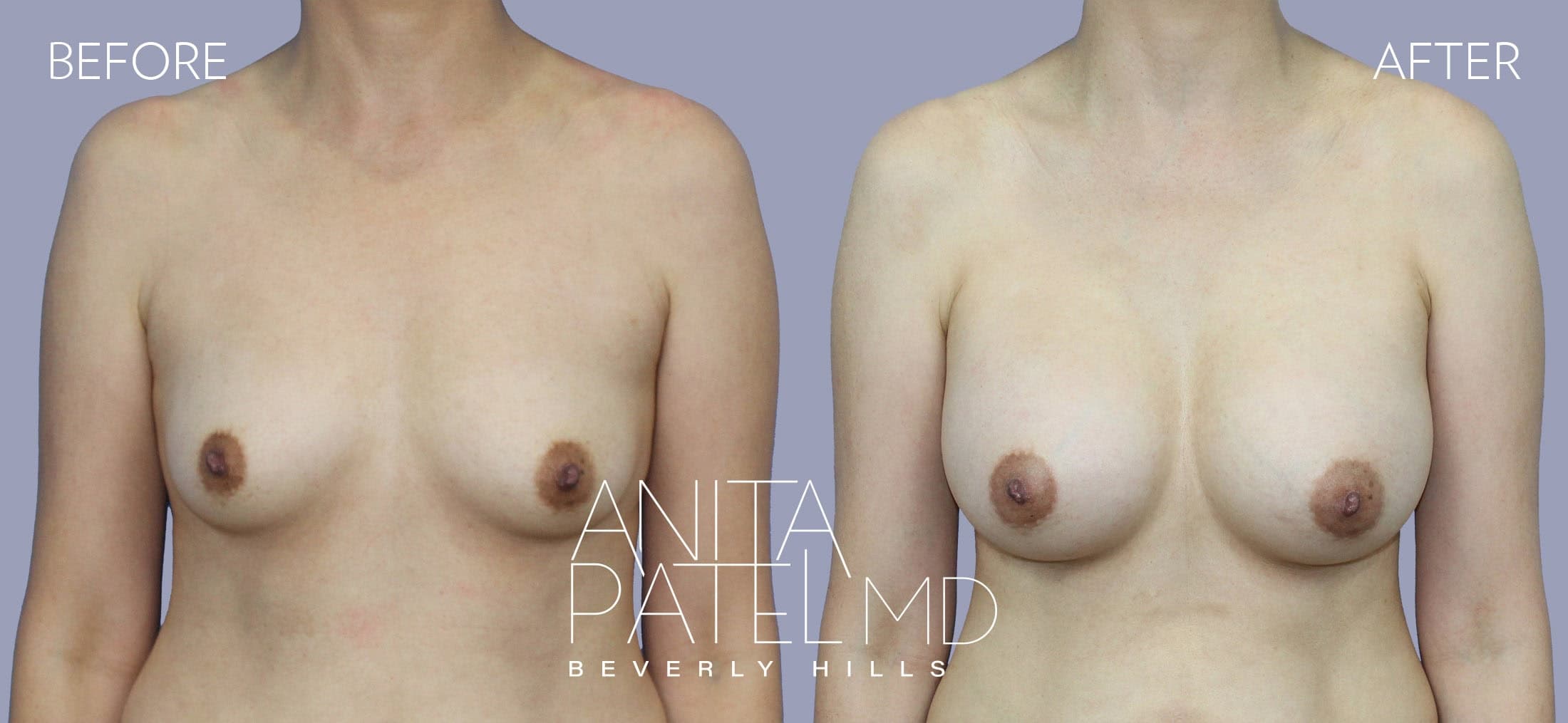 Breast Augmentation before and after — Patient 23, photo 1 of 2 — Dr. Anita Patel, MD, FACS, Beverly Hills