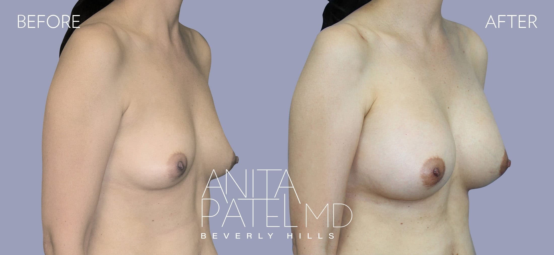 Breast Augmentation before and after — Patient 23, photo 2 of 2 — Dr. Anita Patel, MD, FACS, Beverly Hills