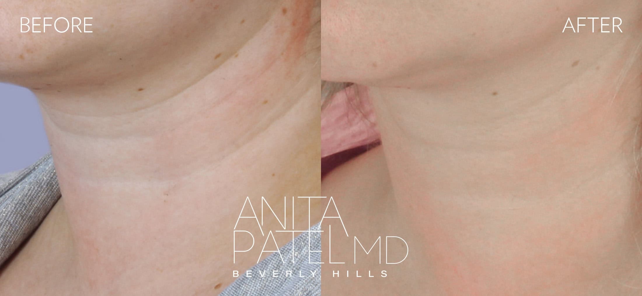 Neurotoxin before and after — Patient 1, photo 2 of 2 — Dr. Anita Patel, MD, FACS, Beverly Hills