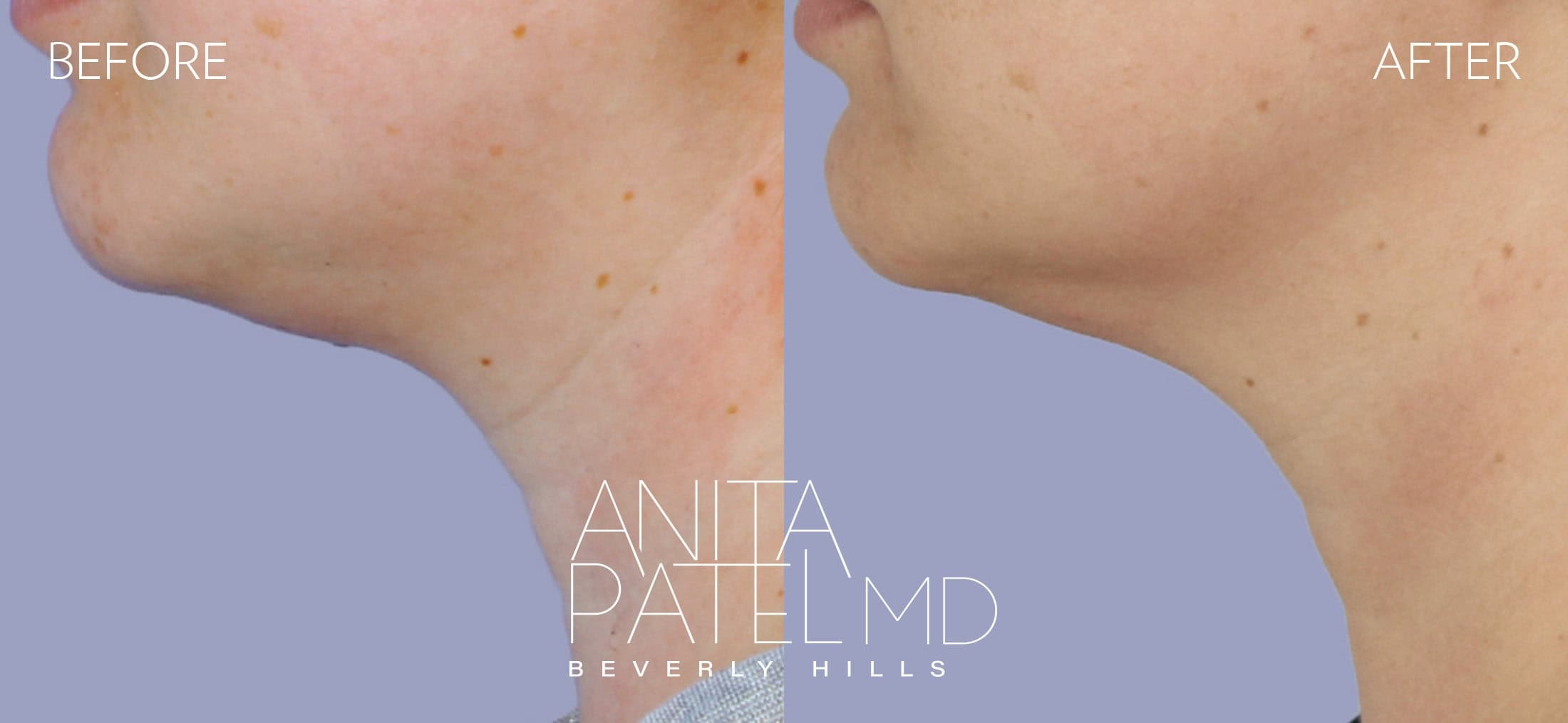 Neurotoxin before and after — Patient 1, photo 1 of 2 — Dr. Anita Patel, MD, FACS, Beverly Hills