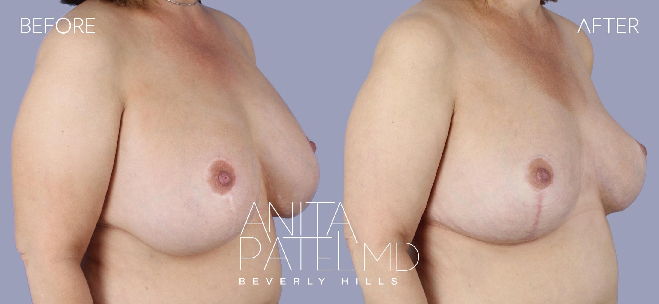 Breast Lift before and after — Patient 10, photo 1 of 2 — Dr. Anita Patel, MD, FACS, Beverly Hills