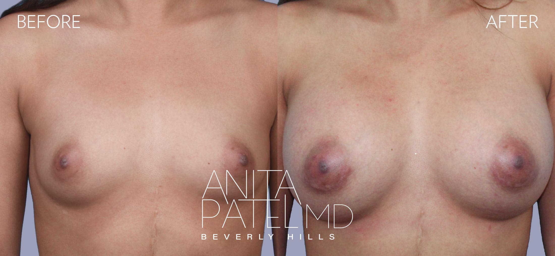 Breast Augmentation before and after — Patient 25 — Dr. Anita Patel, MD, FACS, Beverly Hills