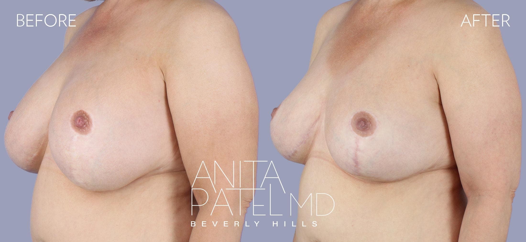 Breast Lift before and after — Patient 10, photo 2 of 2 — Dr. Anita Patel, MD, FACS, Beverly Hills