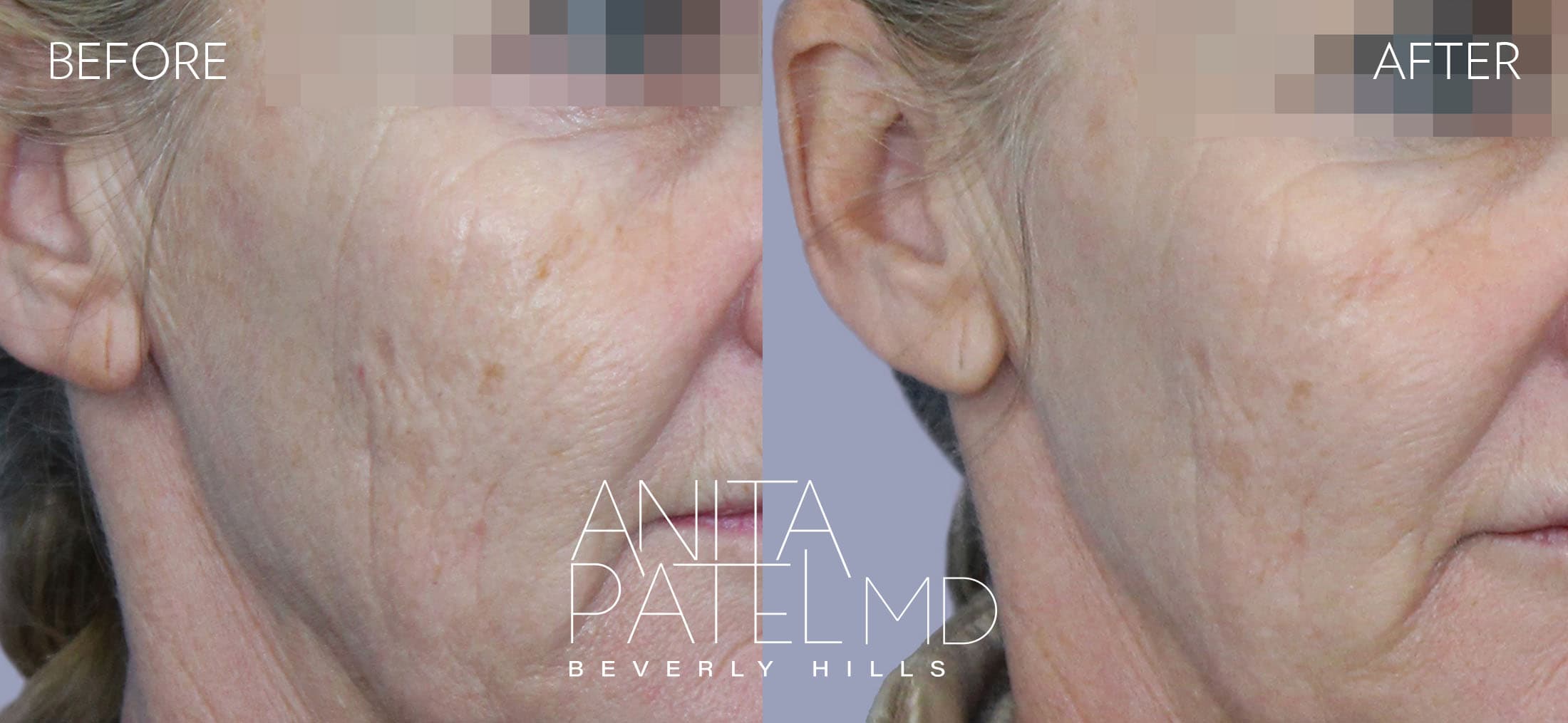 Fractional Laser Aesthetic Treatment before and after — Patient 3 — Dr. Anita Patel, MD, FACS, Beverly Hills