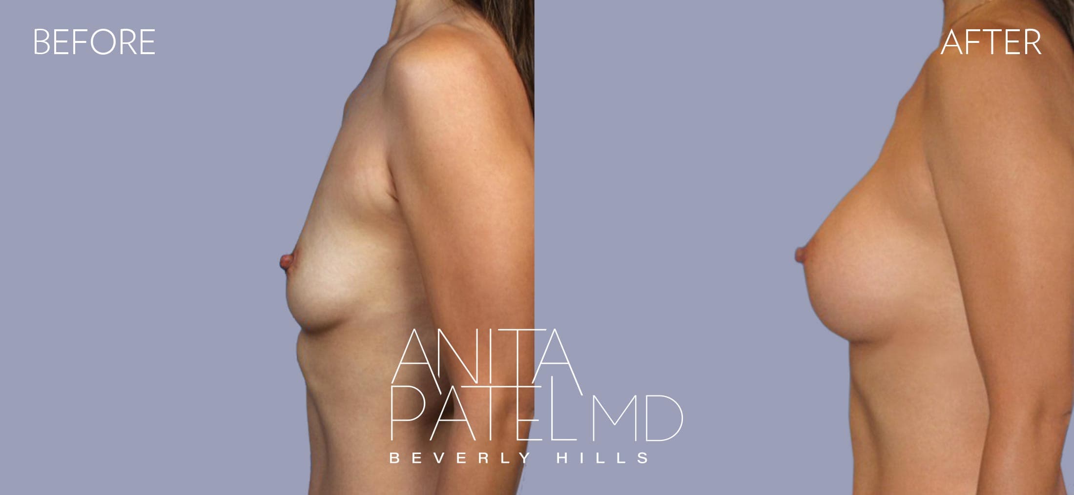 Breast Augmentation before and after — Patient 1, photo 1 of 4 — Dr. Anita Patel, MD, FACS, Beverly Hills