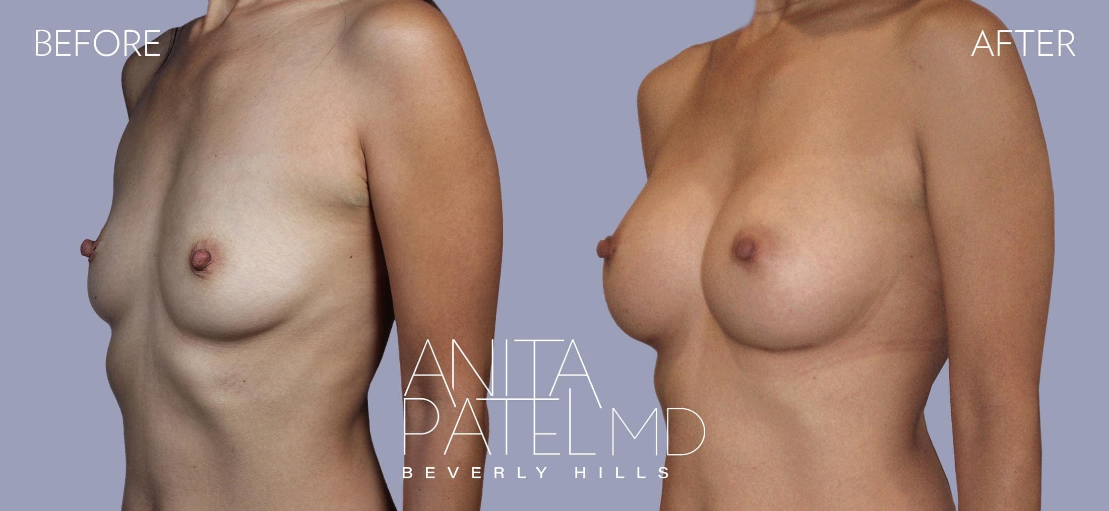 Breast Augmentation before and after — Patient 1, photo 2 of 4 — Dr. Anita Patel, MD, FACS, Beverly Hills