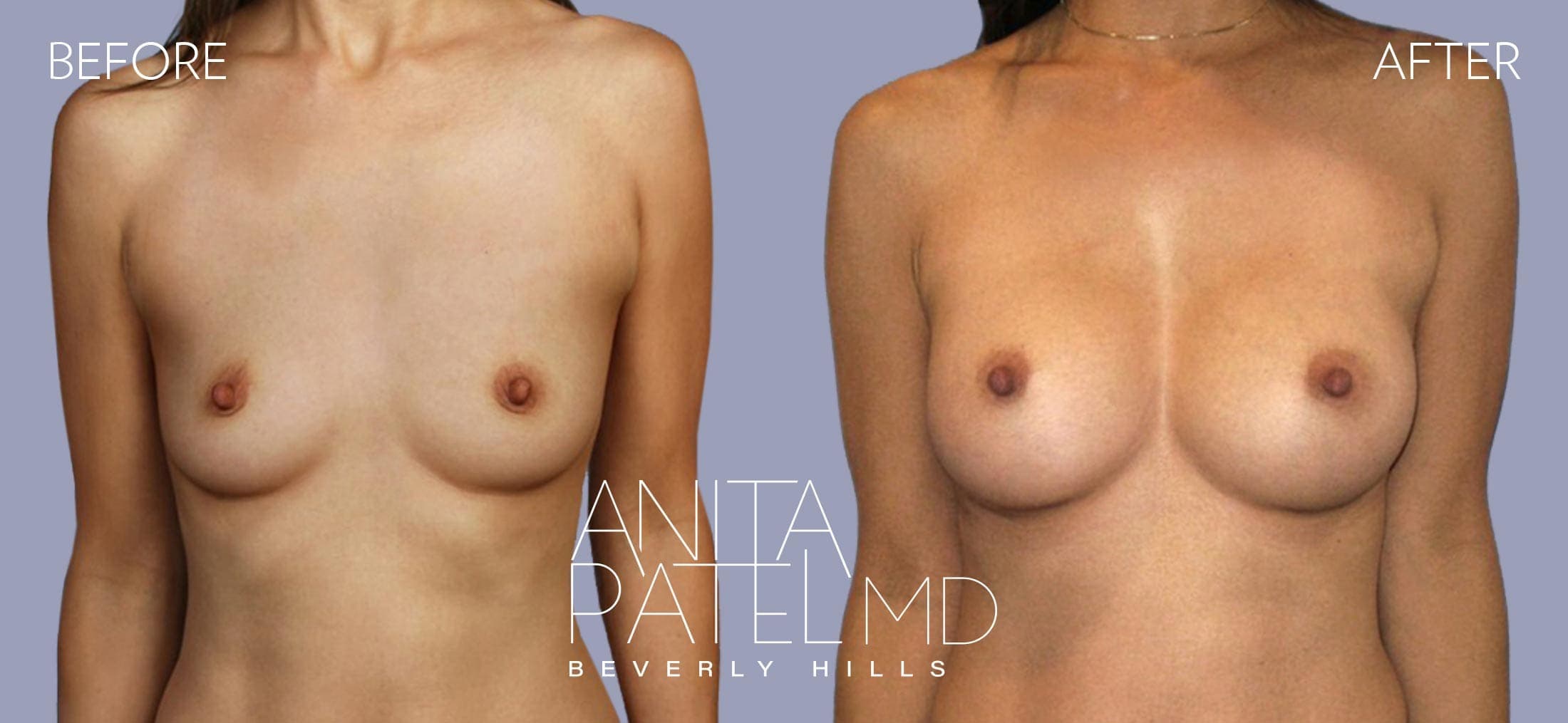 Breast Augmentation before and after — Patient 1, photo 3 of 4 — Dr. Anita Patel, MD, FACS, Beverly Hills