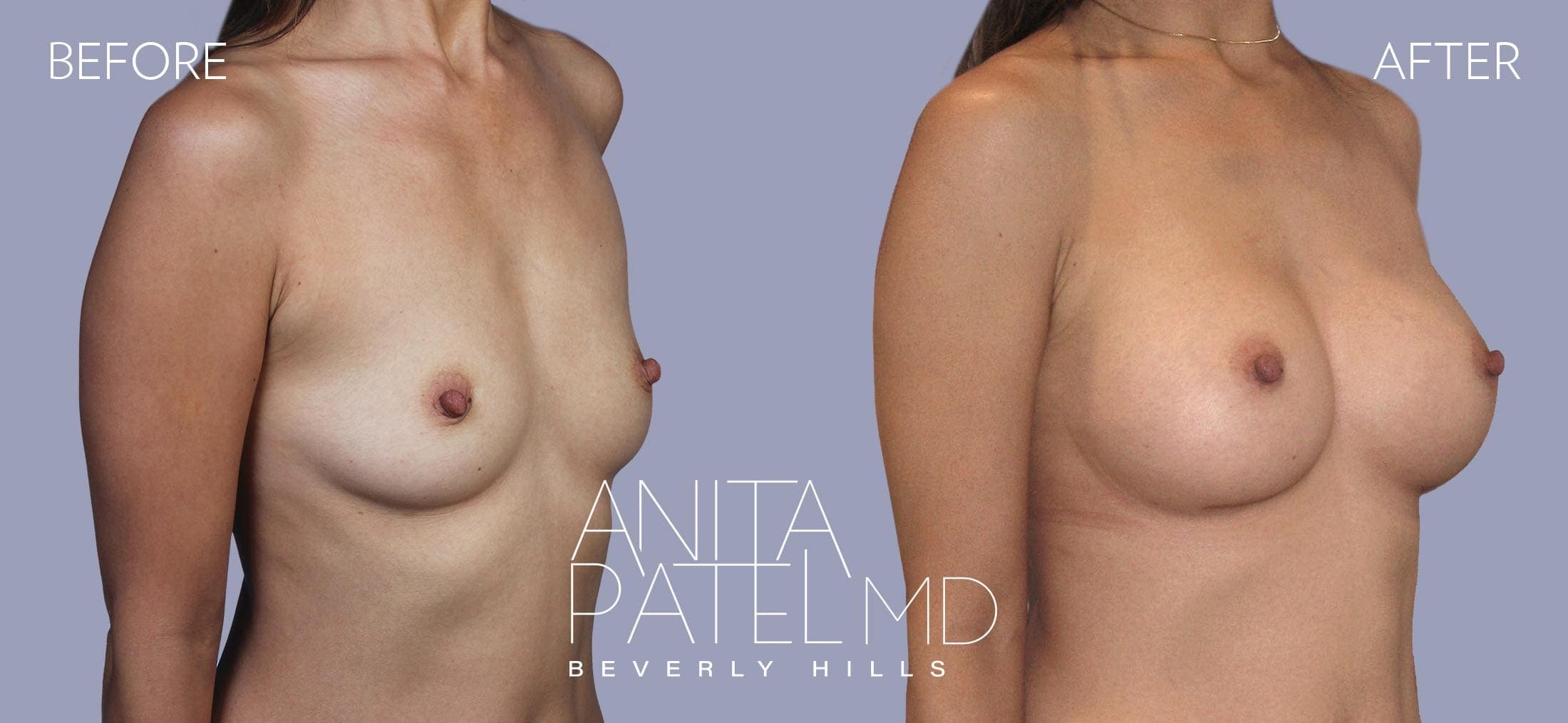 Breast Augmentation before and after — Patient 1, photo 4 of 4 — Dr. Anita Patel, MD, FACS, Beverly Hills