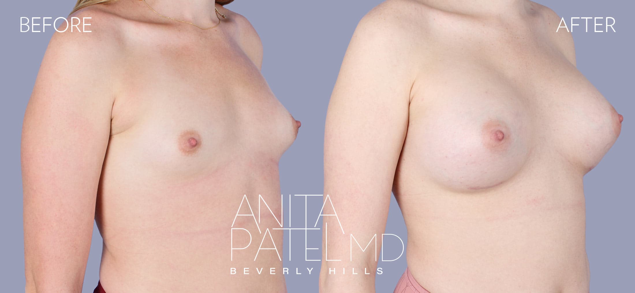 Breast Augmentation before and after — Patient 10 — Dr. Anita Patel, MD, FACS, Beverly Hills