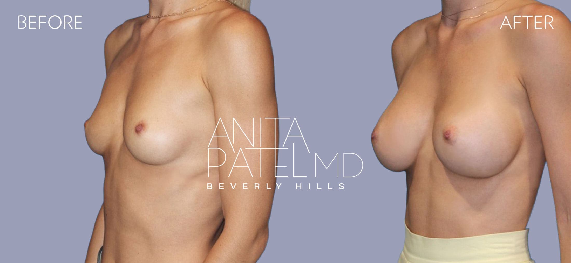 Breast Augmentation before and after — Patient 2, photo 3 of 4 — Dr. Anita Patel, MD, FACS, Beverly Hills