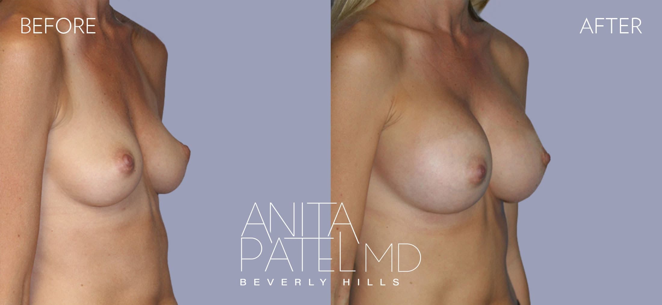 Breast Augmentation before and after — Patient 11, photo 2 of 5 — Dr. Anita Patel, MD, FACS, Beverly Hills