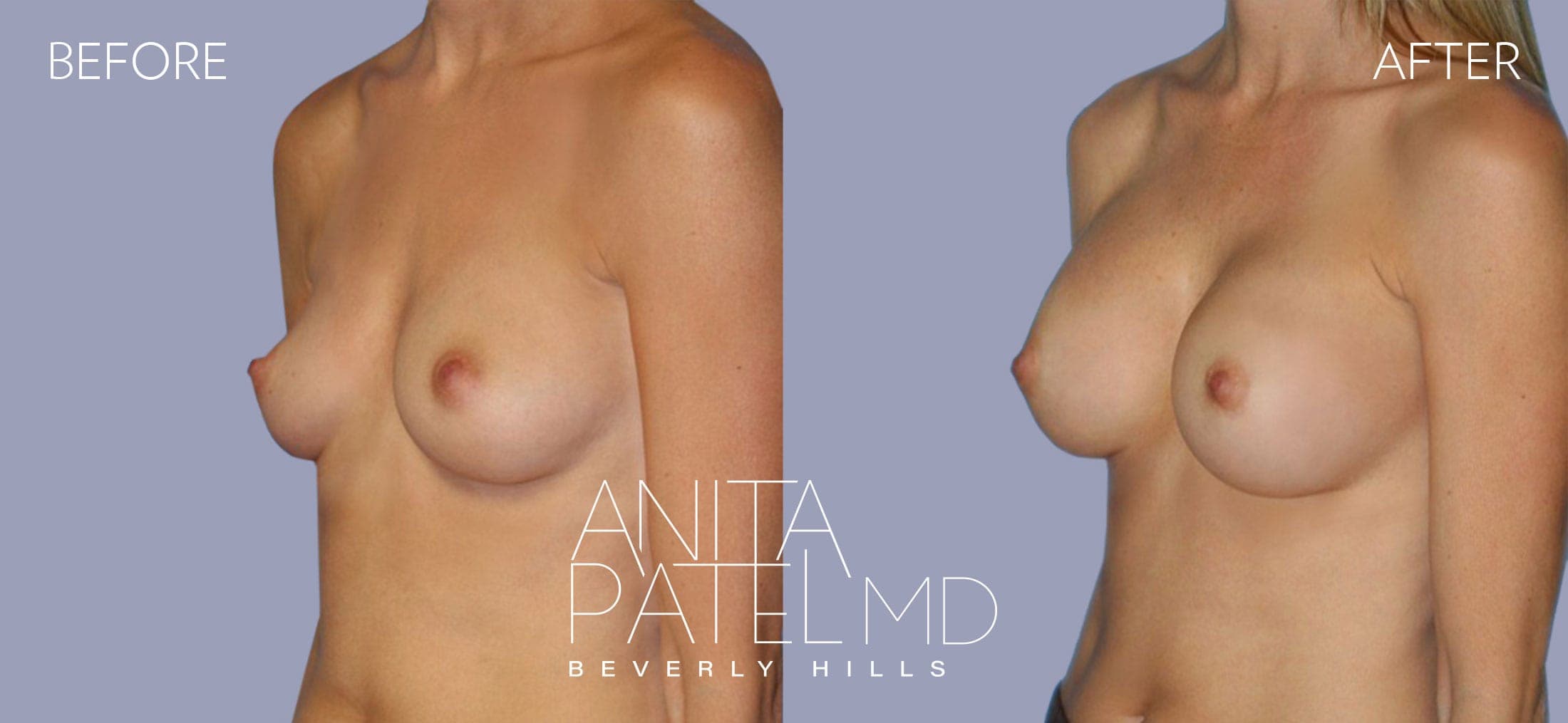 Breast Augmentation before and after — Patient 11, photo 4 of 5 — Dr. Anita Patel, MD, FACS, Beverly Hills