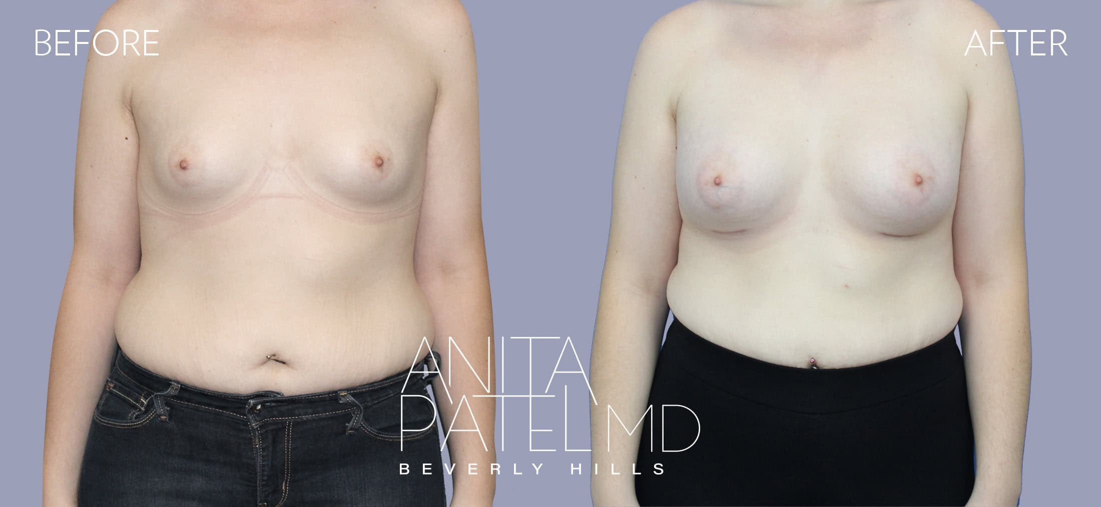 Breast Augmentation before and after — Patient 27 — Dr. Anita Patel, MD, FACS, Beverly Hills