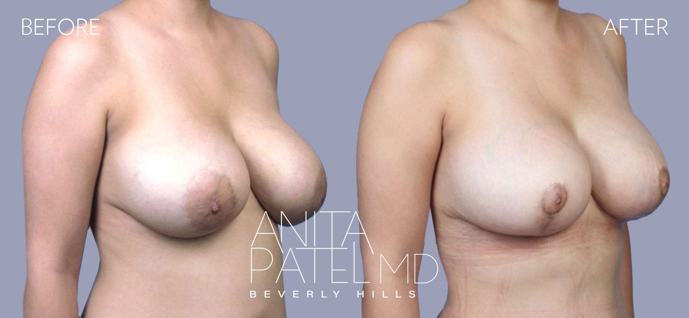 Breast Implant Revision before and after — Patient 6, photo 4 of 5 — Dr. Anita Patel, MD, FACS, Beverly Hills