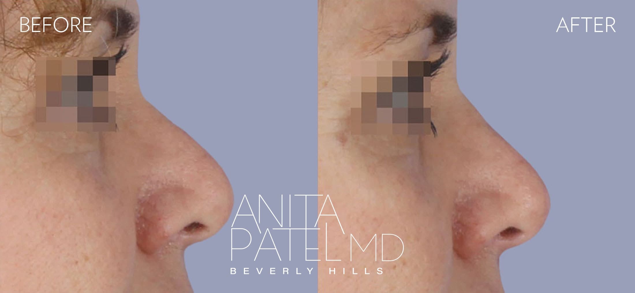Rhinoplasty before and after — Patient 12, photo 2 of 2 — Dr. Anita Patel, MD, FACS, Beverly Hills