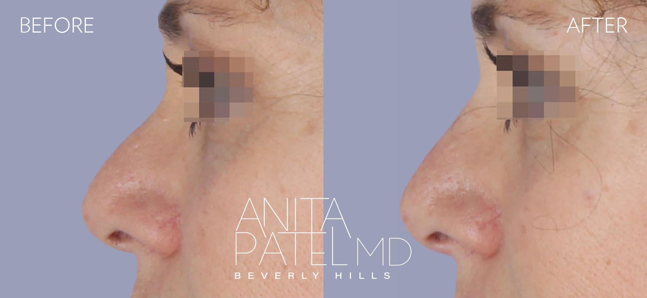 Rhinoplasty before and after — Patient 12, photo 1 of 2 — Dr. Anita Patel, MD, FACS, Beverly Hills