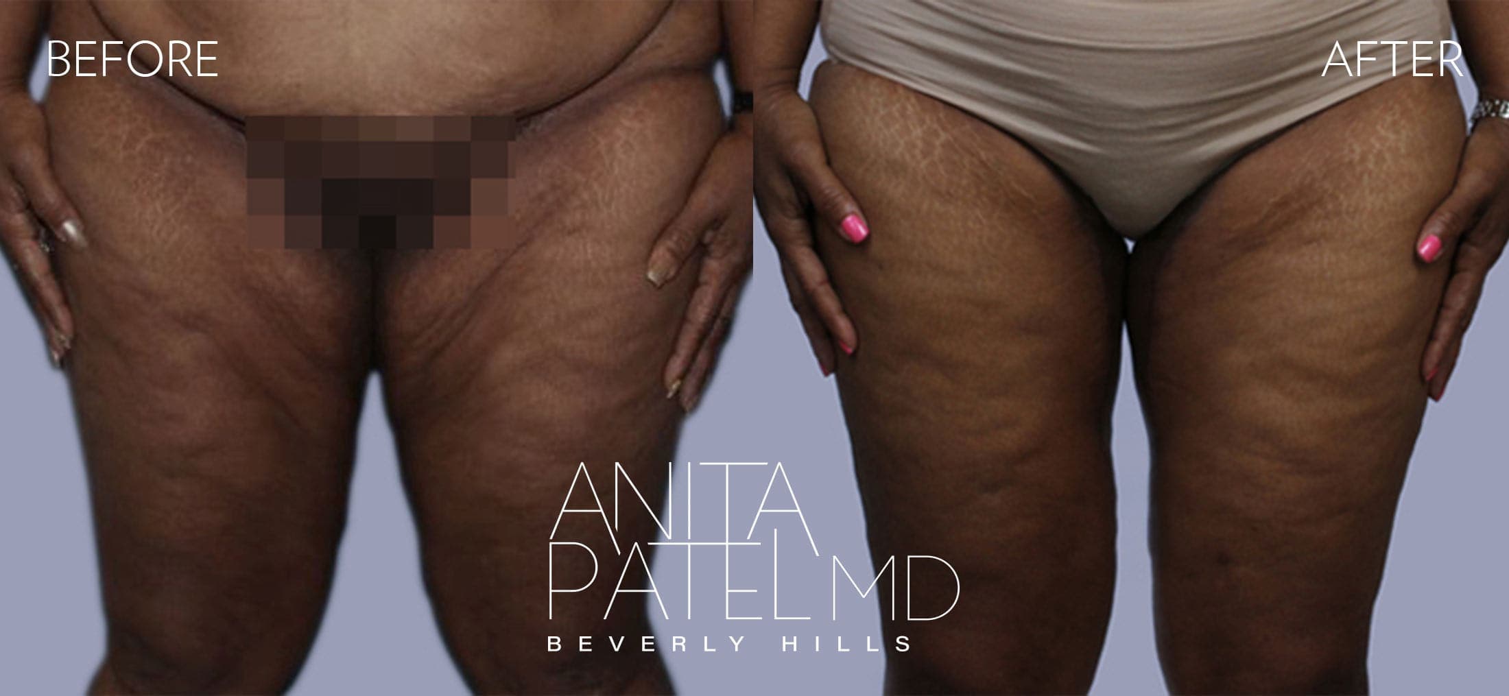 Thigh Lift before and after — Patient 2 — Dr. Anita Patel, MD, FACS, Beverly Hills