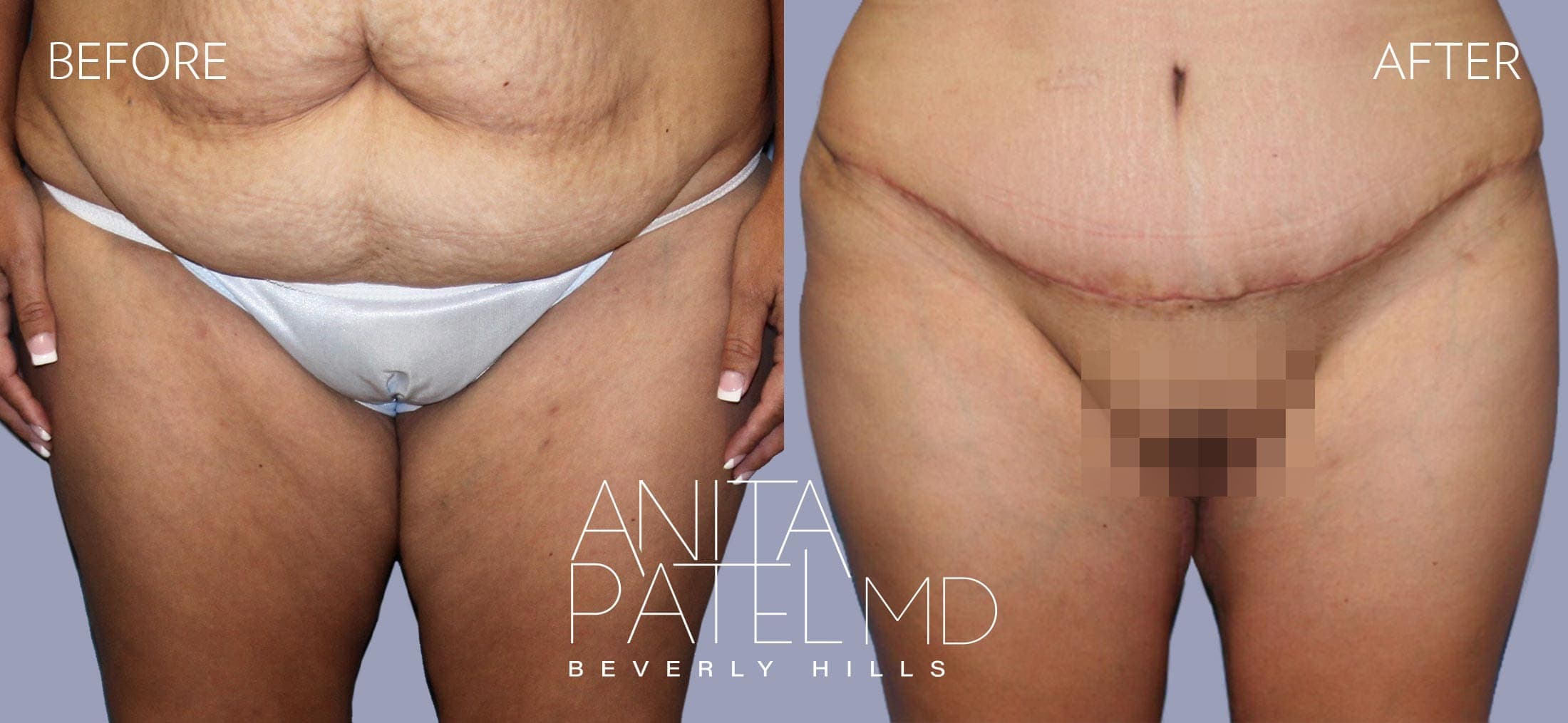 Thigh Lift before and after — Patient 3 — Dr. Anita Patel, MD, FACS, Beverly Hills