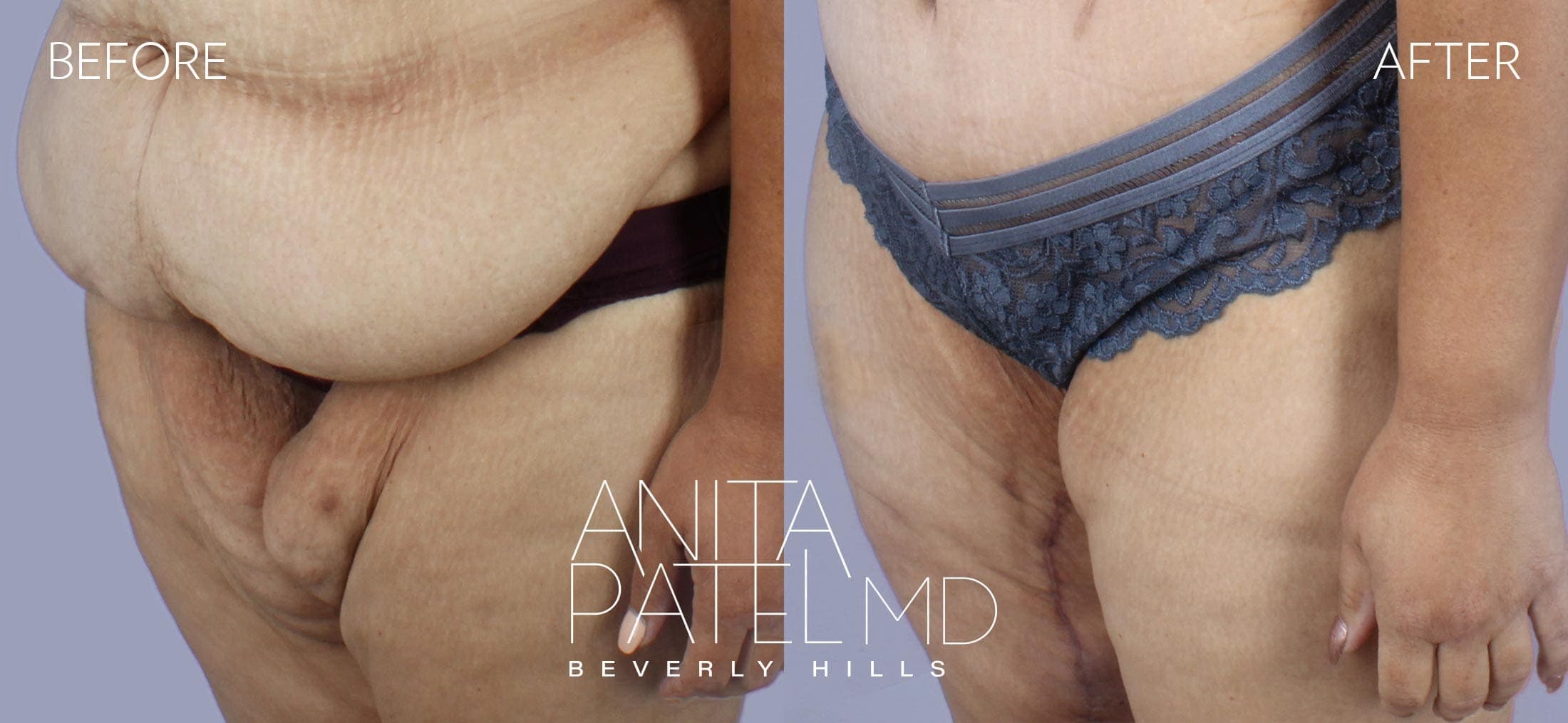 Thigh Lift before and after — Patient 1, photo 2 of 2 — Dr. Anita Patel, MD, FACS, Beverly Hills
