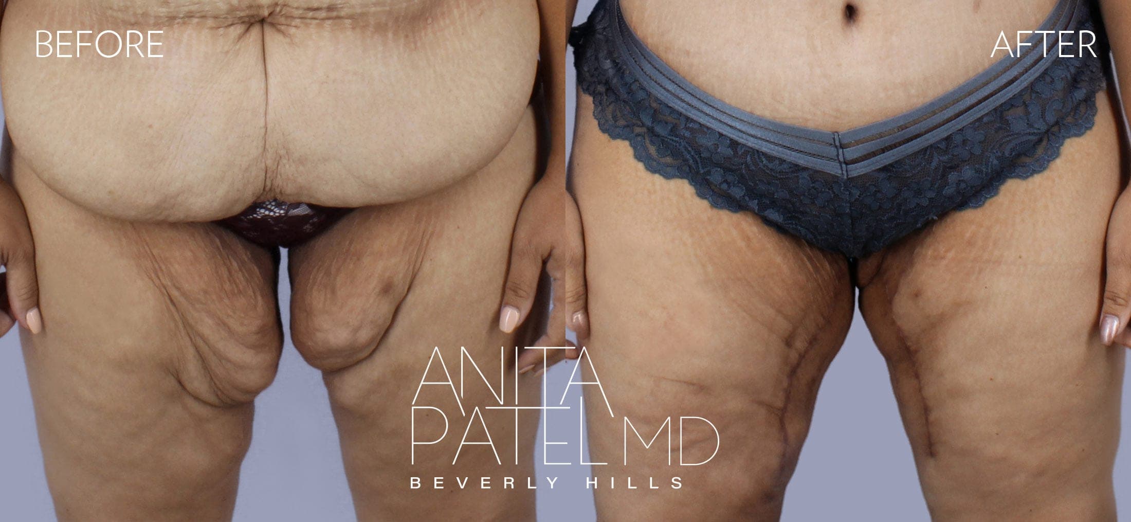 Thigh Lift before and after — Patient 1, photo 1 of 2 — Dr. Anita Patel, MD, FACS, Beverly Hills