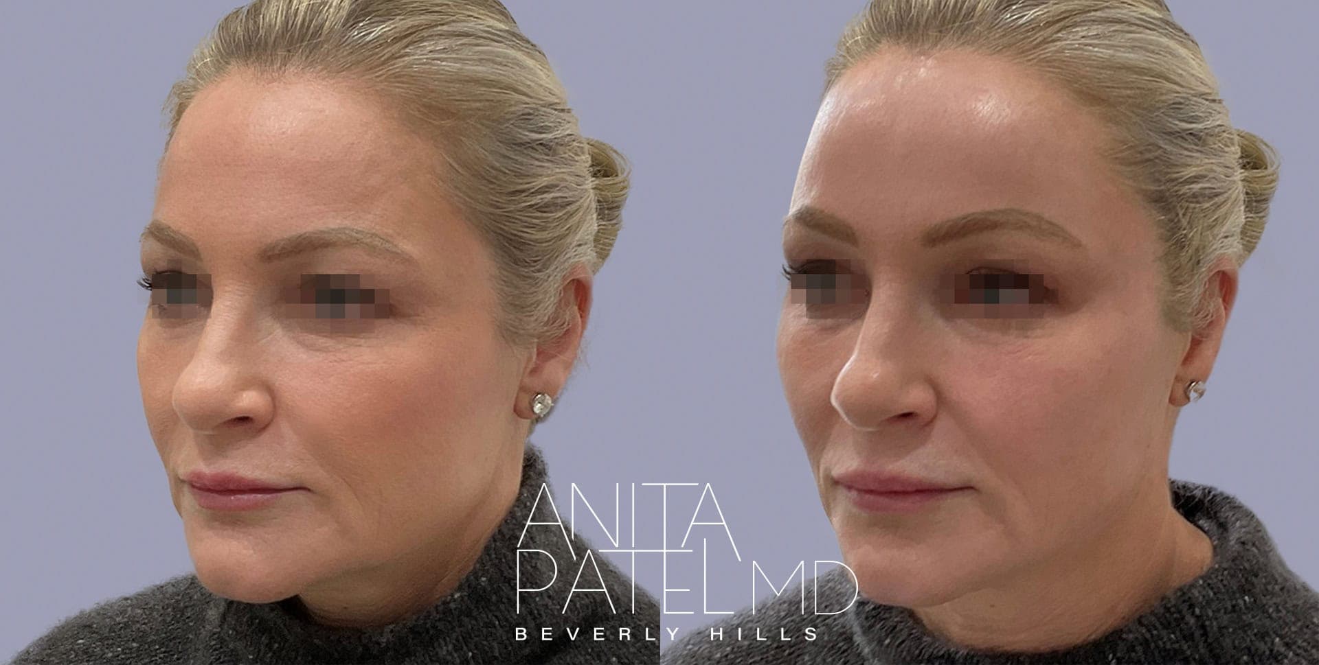 Threadlift before and after — Patient 2 — Dr. Anita Patel, MD, FACS, Beverly Hills