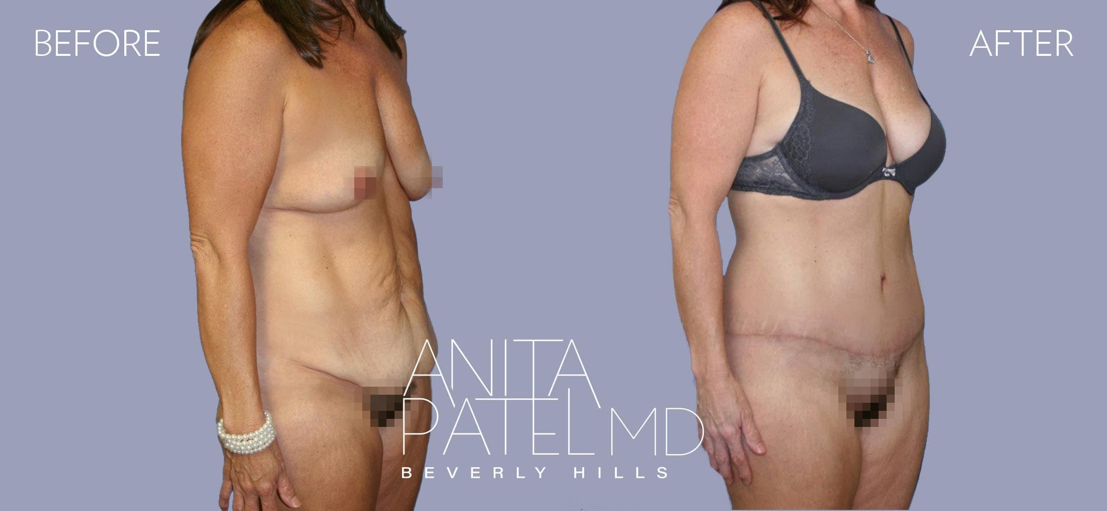 Tummy Tuck before and after — Patient 15, photo 2 of 5 — Dr. Anita Patel, MD, FACS, Beverly Hills