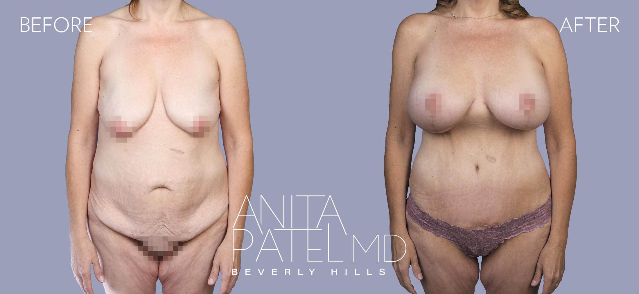 Tummy Tuck before and after — Patient 27 — Dr. Anita Patel, MD, FACS, Beverly Hills
