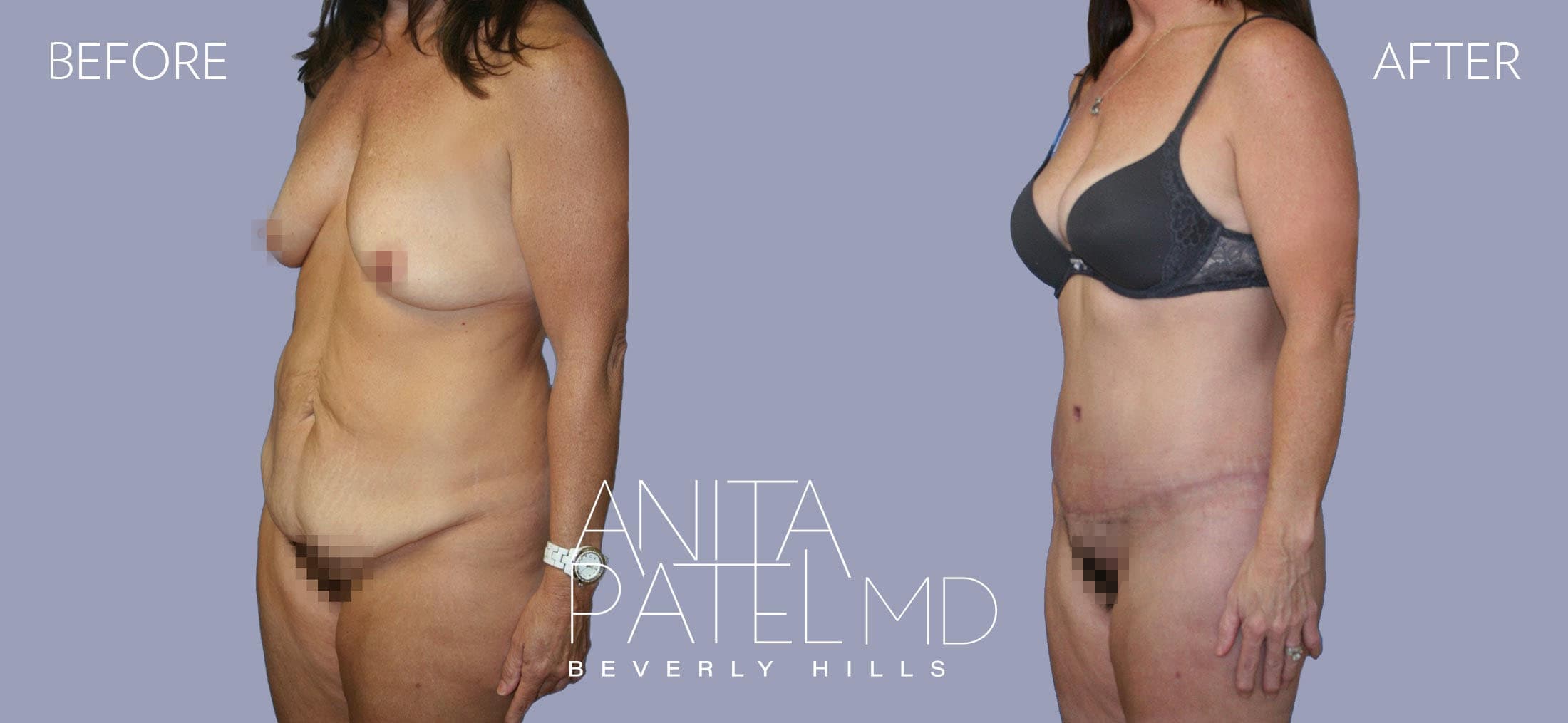 Tummy Tuck before and after — Patient 15, photo 4 of 5 — Dr. Anita Patel, MD, FACS, Beverly Hills