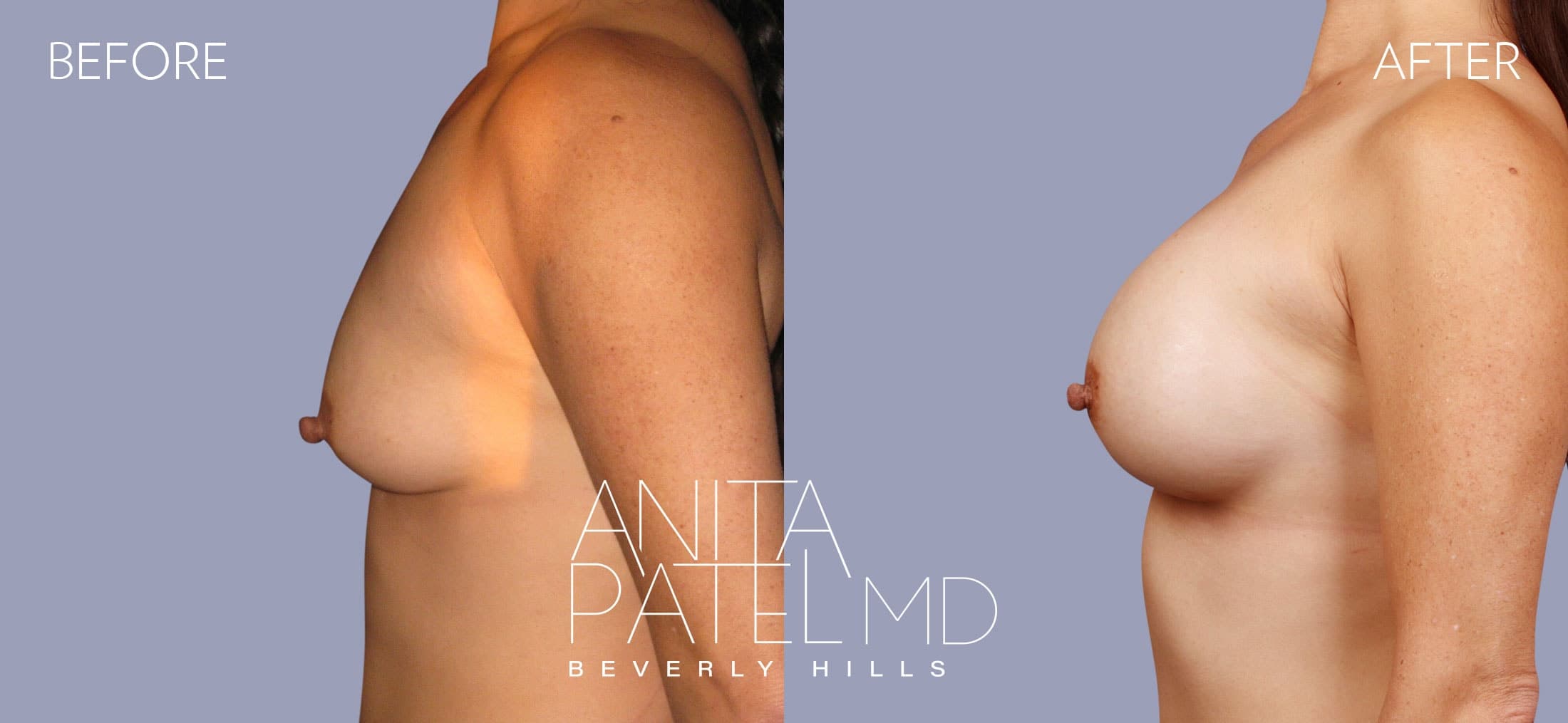 Breast Augmentation before and after — Patient 28, photo 2 of 2 — Dr. Anita Patel, MD, FACS, Beverly Hills