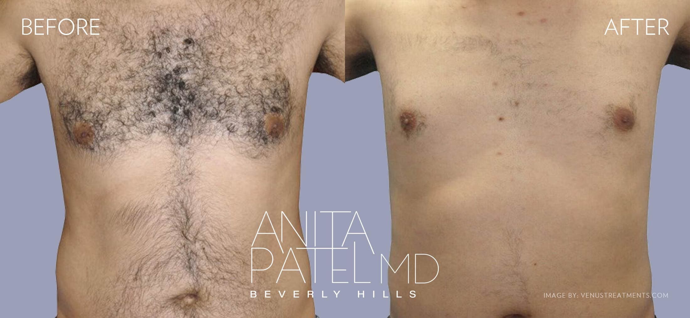 Venus Versa™ Laser Hair Removal before and after — Dr. Anita Patel, Beverly Hills