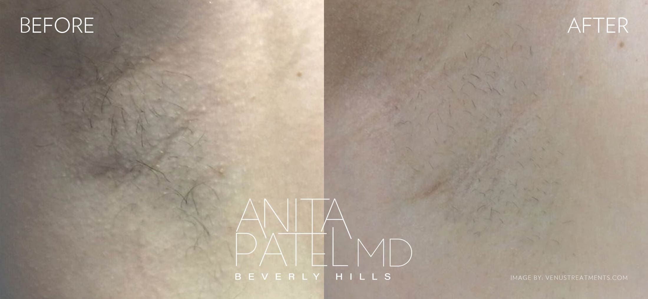 Venus Versa™ Laser Hair Removal before and after — Patient 2 — Dr. Anita Patel, MD, FACS, Beverly Hills
