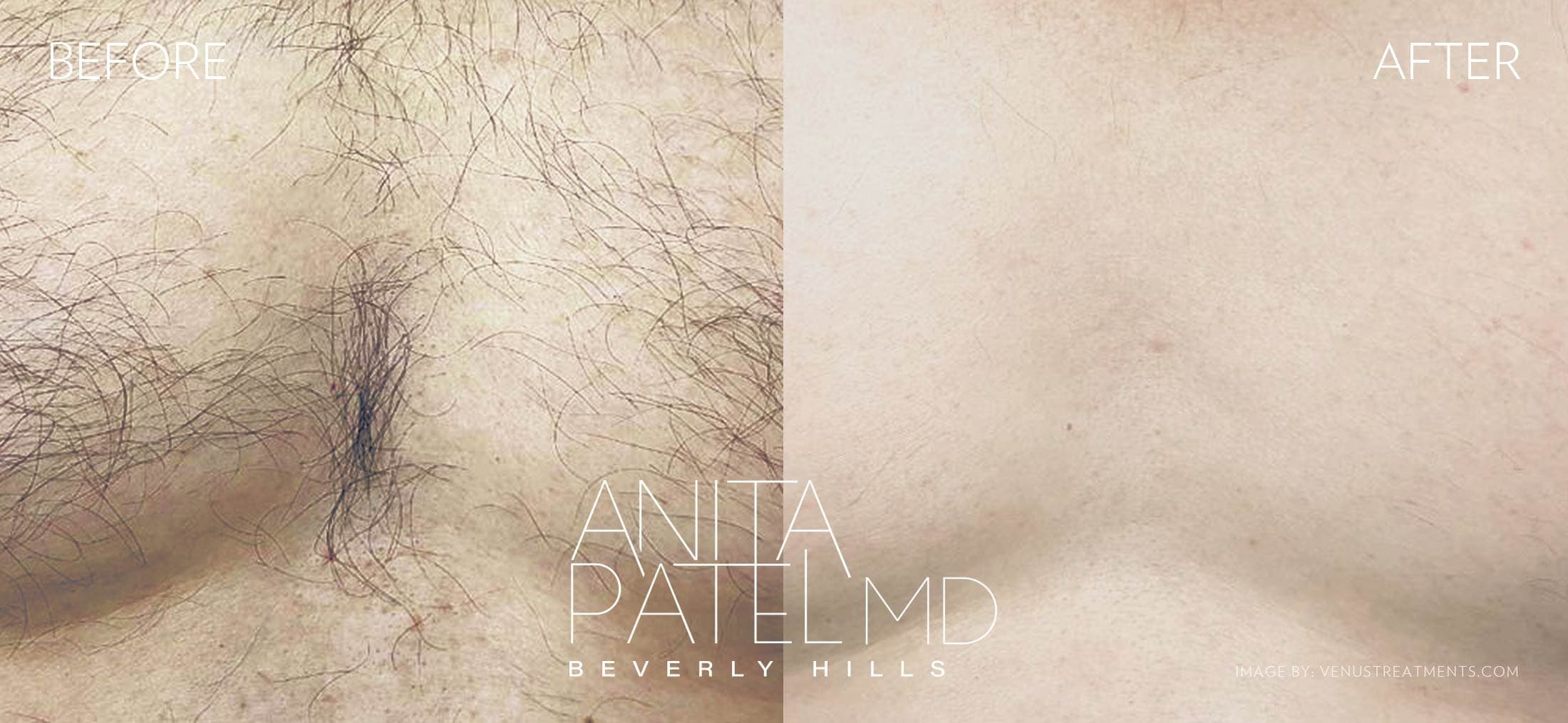 Venus Versa™ Laser Hair Removal before and after — Patient 3 — Dr. Anita Patel, MD, FACS, Beverly Hills
