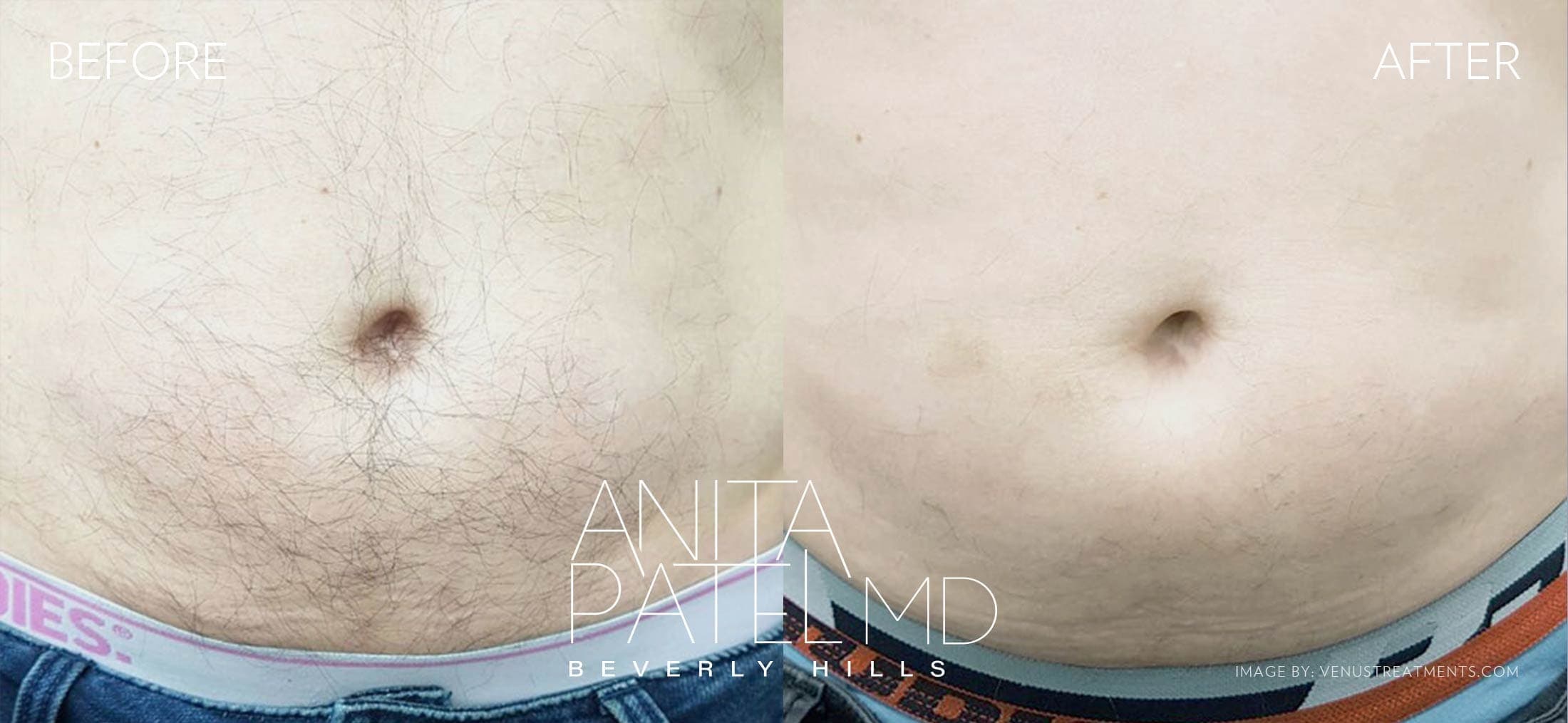 Venus Versa™ Laser Hair Removal before and after — Patient 4 — Dr. Anita Patel, MD, FACS, Beverly Hills
