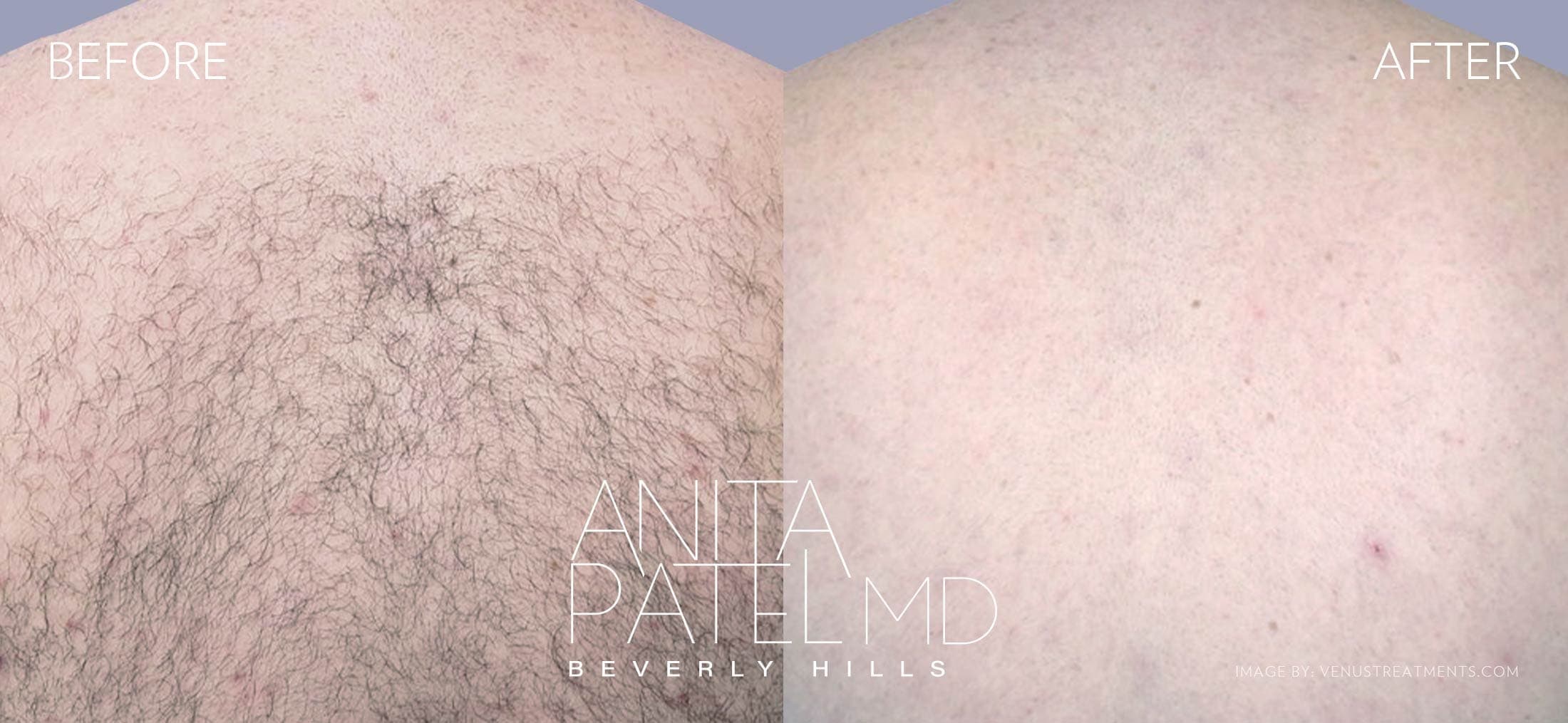 Venus Versa™ Laser Hair Removal before and after — Patient 5 — Dr. Anita Patel, MD, FACS, Beverly Hills