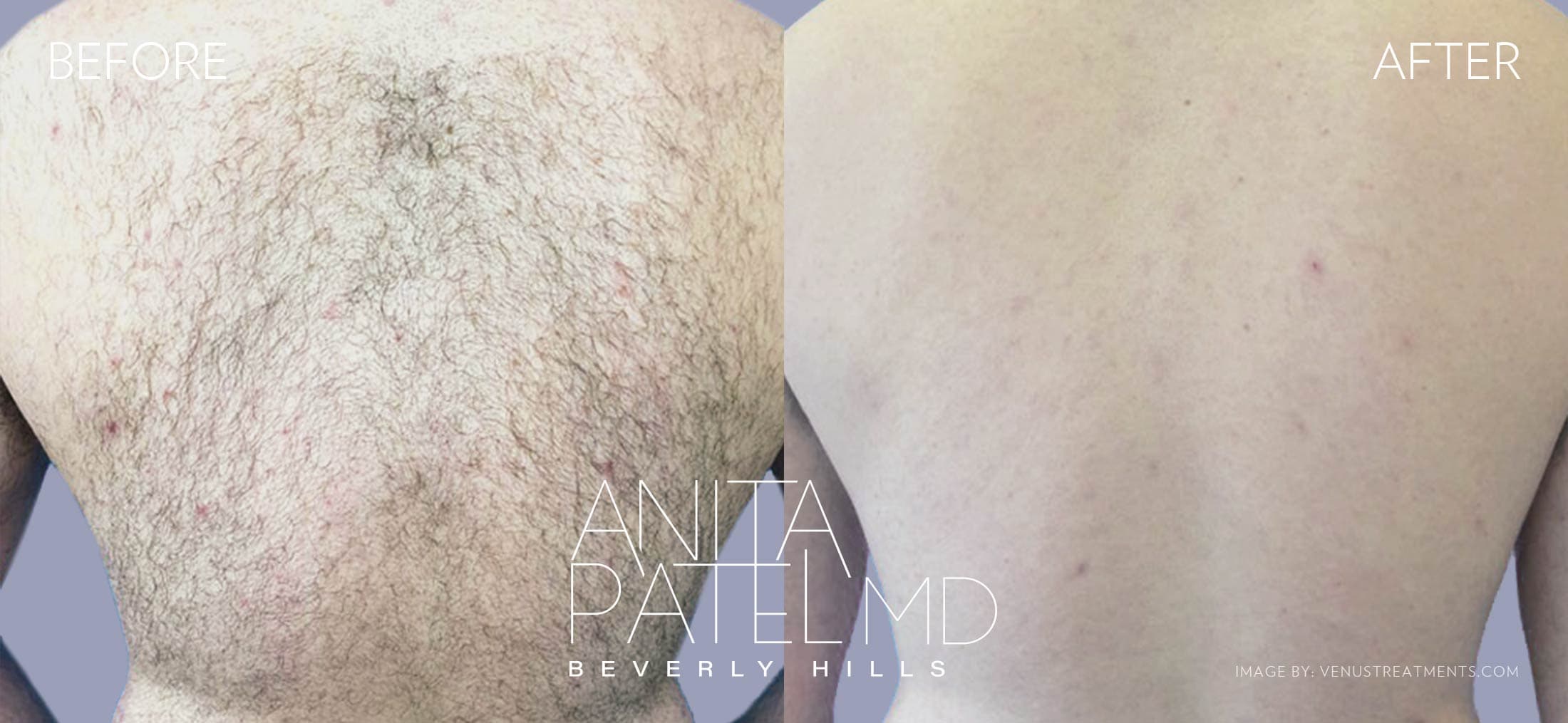 Venus Versa™ Laser Hair Removal before and after — Patient 6 — Dr. Anita Patel, MD, FACS, Beverly Hills