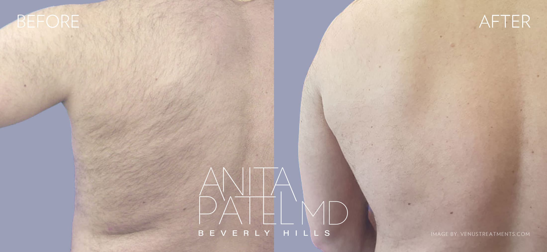 Venus Versa™ Laser Hair Removal before and after — Patient 7 — Dr. Anita Patel, MD, FACS, Beverly Hills