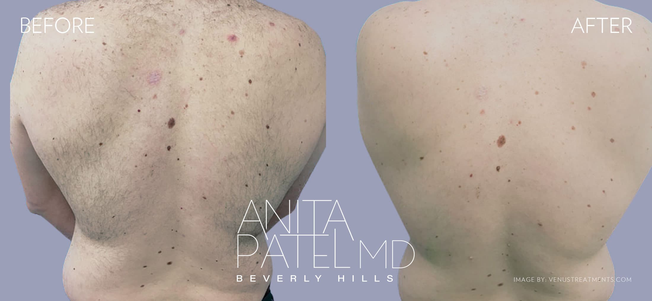 Venus Versa™ Laser Hair Removal before and after — Patient 8 — Dr. Anita Patel, MD, FACS, Beverly Hills