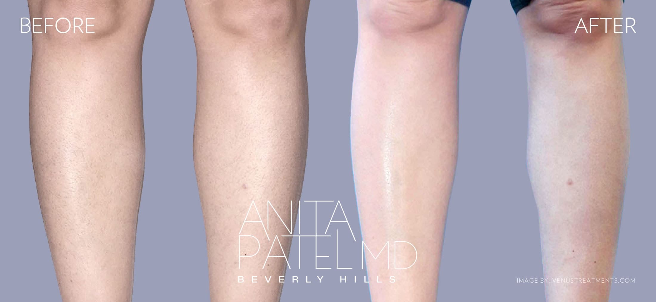 Venus Versa™ Laser Hair Removal before and after — Patient 9 — Dr. Anita Patel, MD, FACS, Beverly Hills