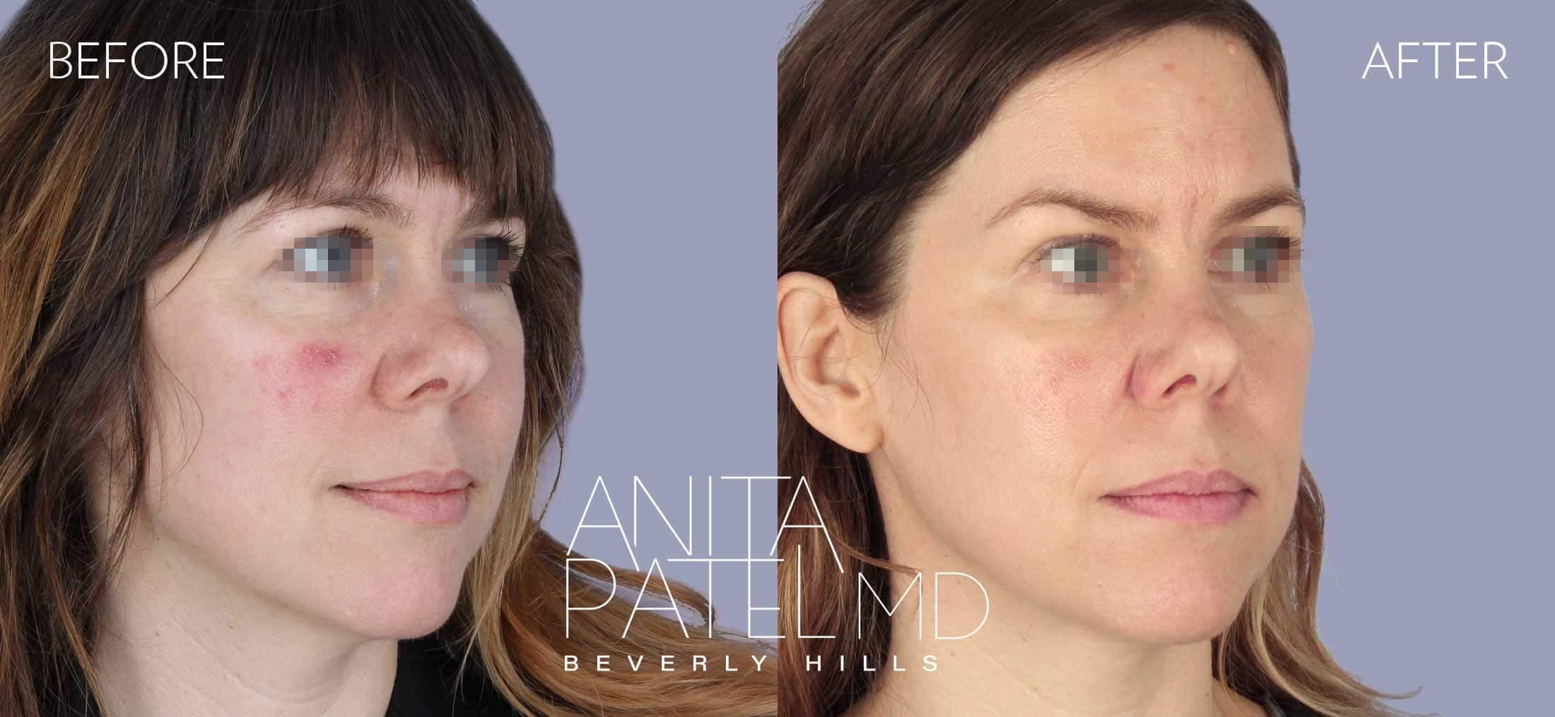 Skin Resurfacing before and after — Patient 1, photo 2 of 5 — Dr. Anita Patel, MD, FACS, Beverly Hills